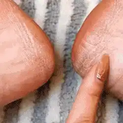 Electric remover